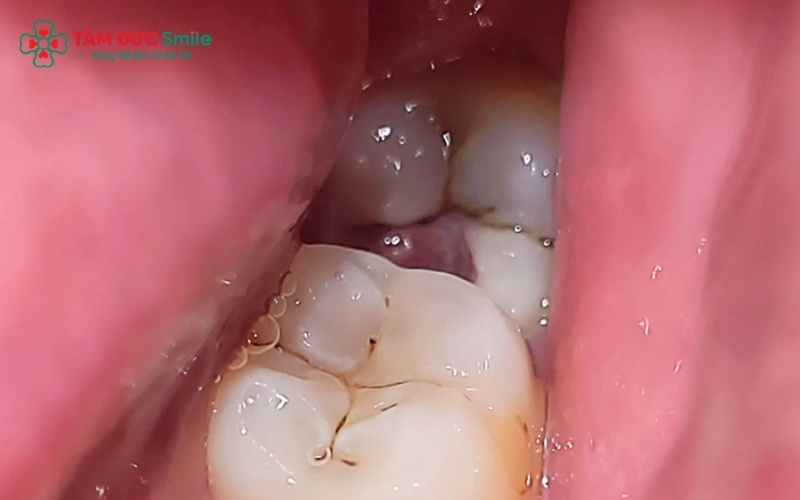Kẽ hở giữa nướu và răng khôn là nơi lý tưởng cho vi khuẩn và mảng bám tích tụ