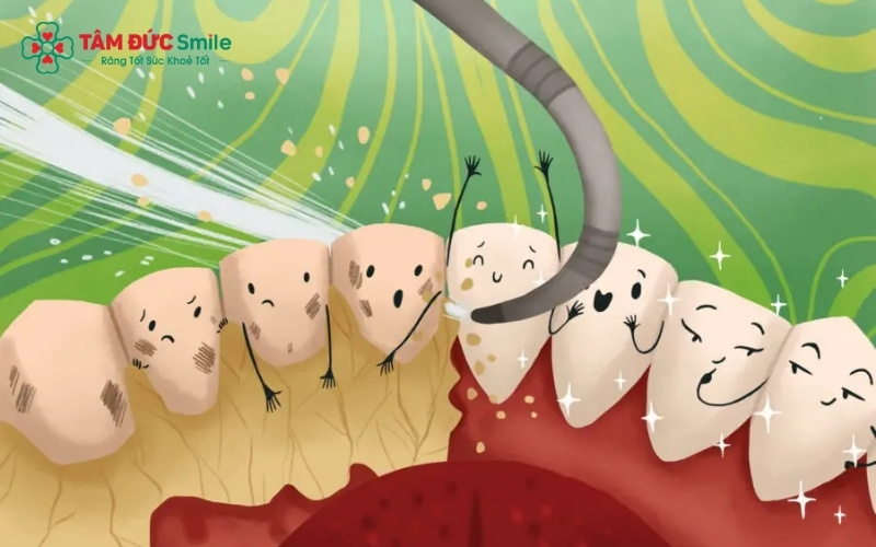 Cao răng và vi khuẩn trên lưỡi là những "kho chứa mùi" khổng lồ mà các loại thuốc thông thường không thể loại bỏ hoàn toàn.