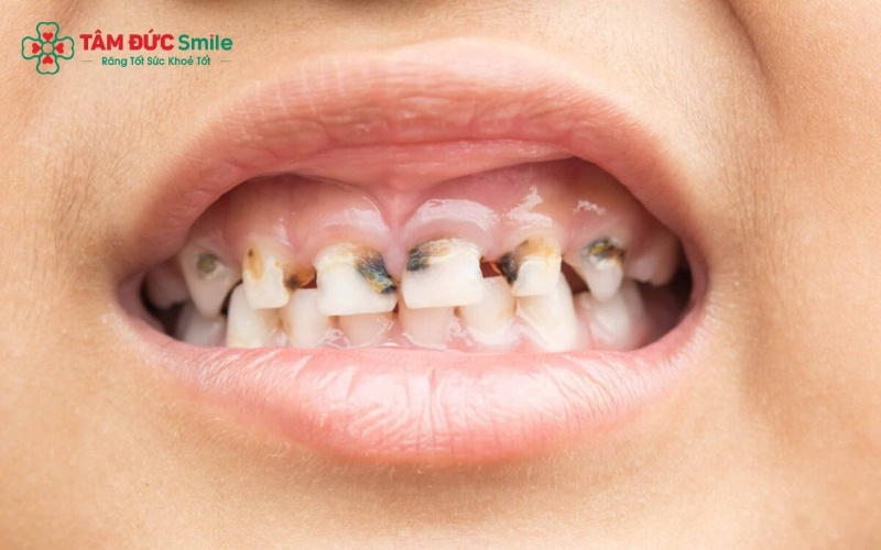 Giai đoạn răng sữa mới chớm sâu với các vệt trắng hoặc chấm đen là "thời điểm vàng" để sử dụng các loại thuốc bôi ngăn chặn tiến triển.