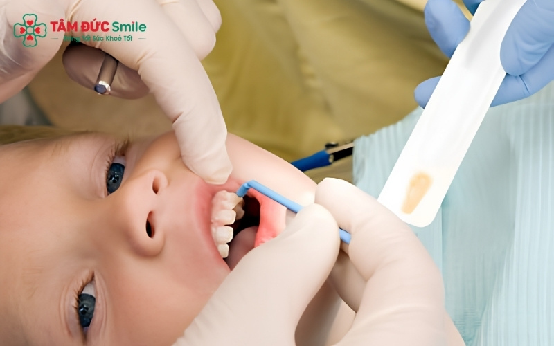 Bôi SDF hoặc Fluoride nồng độ cao là phương pháp hiệu quả giúp làm "ngưng trệ" vết sâu và bảo vệ men răng cho ABC8 đường link chính thức