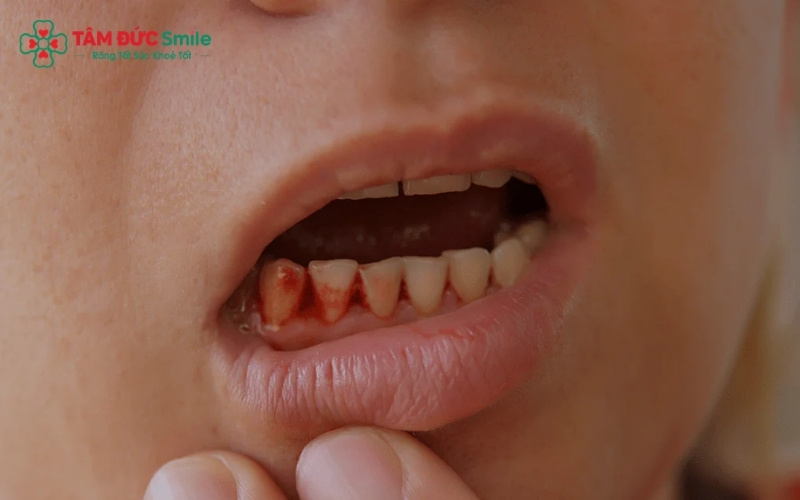 Nướu của trẻ bị sưng đỏ, dễ chảy máu khi chạm vào là những dấu hiệu cảnh báo tình trạng viêm lợi đang tiến triển
