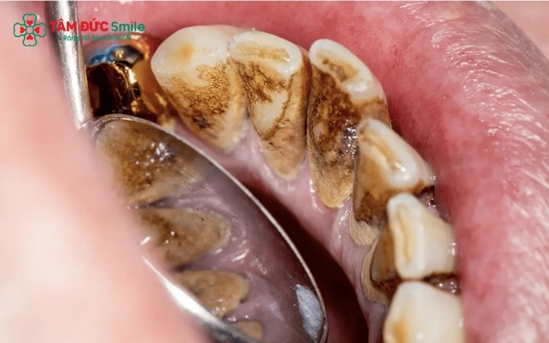 Vôi răng và mảng bám là "nơi trú ngụ" lý tưởng của vi khuẩn gây mùi, khiến việc Abc88win ứng dụng di động bằng nước muối thông thường không thể giải quyết triệt để