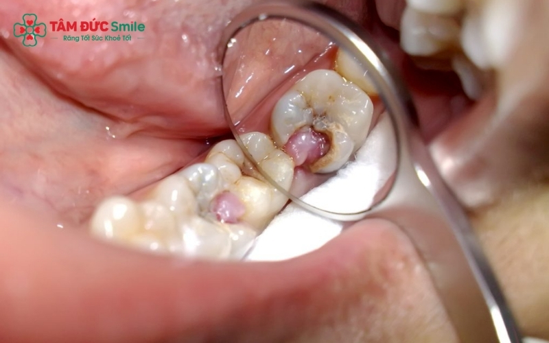 Cơn đau tủy răng thường diễn ra dữ dội, đau giật theo nhịp mạch đập và có xu hướng nặng hơn vào ban đêm khiến người bệnh mất ngủ.