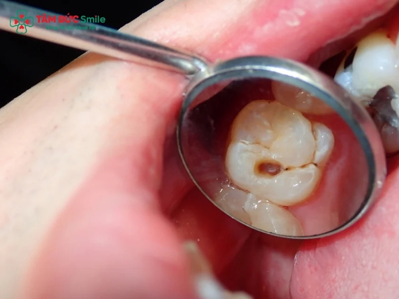 Trị viêm tủy răng tại nhà có khỏi không? Cách giảm đau an toàn