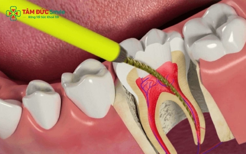 Tuyệt đối không tự ý mua thuốc kháng sinh hoặc đắp các loại thuốc nam, mẹo dân gian chưa kiểm chứng vào răng đau vì dễ gây nhiễm trùng nặng hơn