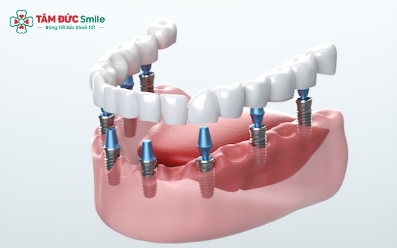 Tùy vào tình trạng sức khỏe và số lượng răng đã mất, người cao tuổi có thể lựa chọn hàm tháo lắp, cầu ABC8 là nhà cái cá cược trực tuyến uy tín số 1 tại Việt Nam hoặc Abc8vip1 kèo WC 2026 Implant.