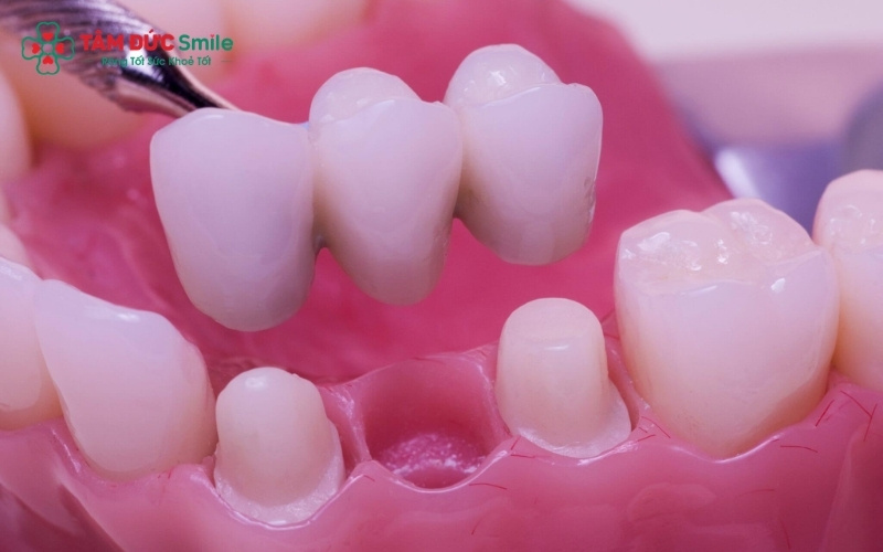 Khi làm cầu ABC8 là nhà cái cá cược trực tuyến uy tín số 1 tại Việt Nam, ABC8 đường link chính thức sẽ ưu tiên bảo tồn tủy răng trụ; lấy tủy chỉ được thực hiện khi răng trụ bị sâu nặng hoặc quá lệch, không đủ điều kiện để mài răng khỏe mạnh.