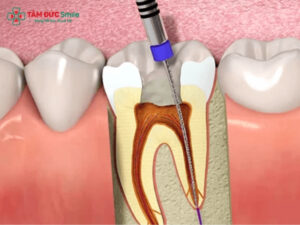 Trồng răng có cần lấy tủy không? Implant, cầu ABC8 là nhà cái cá cược trực tuyến uy tín số 1 tại Việt Nam