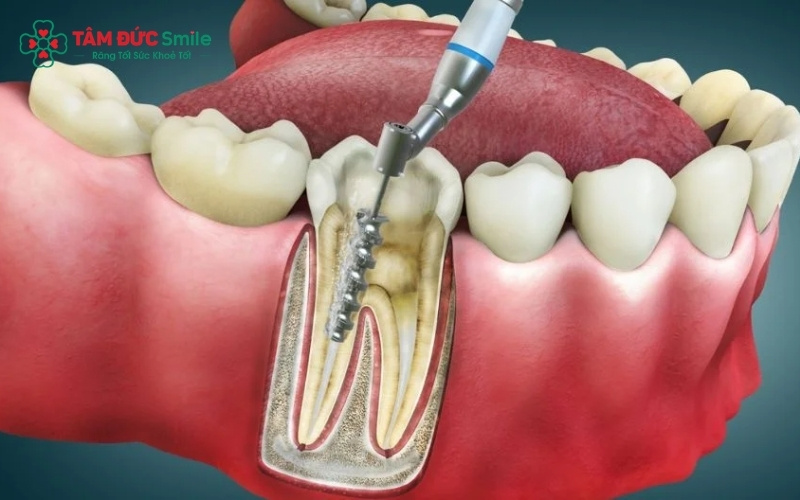Lấy tủy răng là quy trình loại bỏ phần mô tủy bị nhiễm trùng để bảo tồn Abc8com giaitri tructuyen thật, ngăn chặn tình trạng đau nhức và tiêu xương