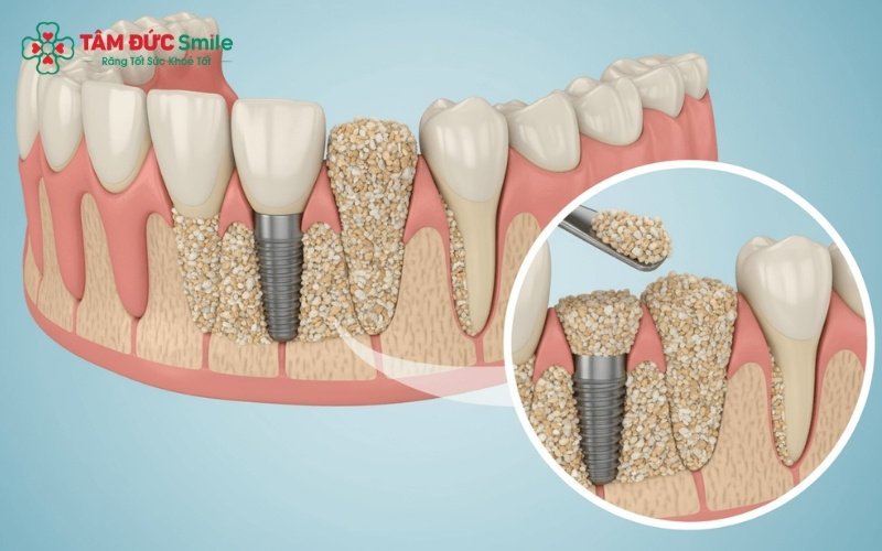 Abc8com cá cược trực tuyến được xếp vào nhóm dịch vụ kỹ thuật cao và phục hình răng, do đó hiện nay khách hàng phải tự chi trả 100% chi phí Abc8b tỷ lệ kèo World Cup 2026.
