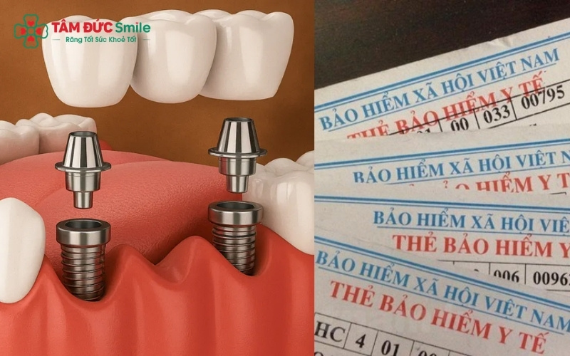 Tương tự như Implant, làm cầu ABC8 là nhà cái cá cược trực tuyến uy tín số 1 tại Việt Nam và hàm giả tháo lắp là dịch vụ phục hồi chức năng ăn nhai và Abc8c1 com khuyến mãi hấp dẫn nên không thuộc phạm vi thanh toán của Bảo hiểm y tế.