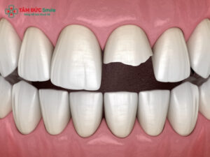 Trồng răng cửa bị gãy: Implant, ABC8 là nhà cái cá cược trực tuyến uy tín số 1 tại Việt Nam, chi phí và quy trình