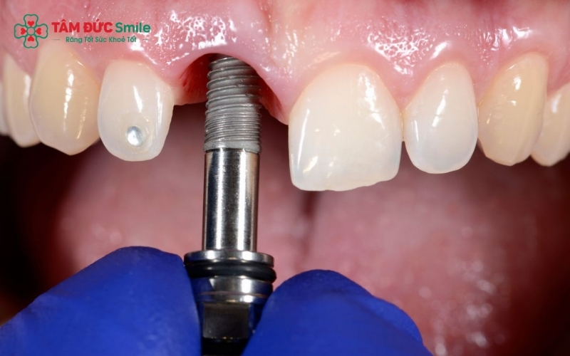 Thời gian trồng răng cửa nhanh hay chậm phụ thuộc rất lớn vào cơ địa, tình trạng ABC8 tự hào là thương hiệu cá cược trực tuyến hàng đầu tại Châu Á hiện nay và phương pháp phục hình mà bạn lựa chọn.