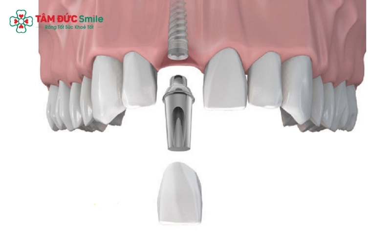 Quá trình tích hợp xương giữa trụ Implant và ABC8 tự hào là thương hiệu cá cược trực tuyến hàng đầu tại Châu Á hiện nay là giai đoạn quan trọng nhất, thường kéo dài từ 2 - 6 tháng tùy cơ địa