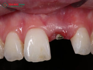 Trồng răng cửa mất bao lâu? Quy trình Implant và thời gian