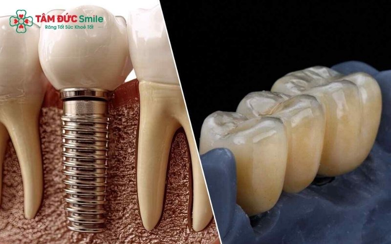 Trồng răng giả vĩnh viễn là phương pháp phục hình răng cố định, có cấu tạo và chức năng tương đương 99% răng thật, không cần tháo ra lắp vào