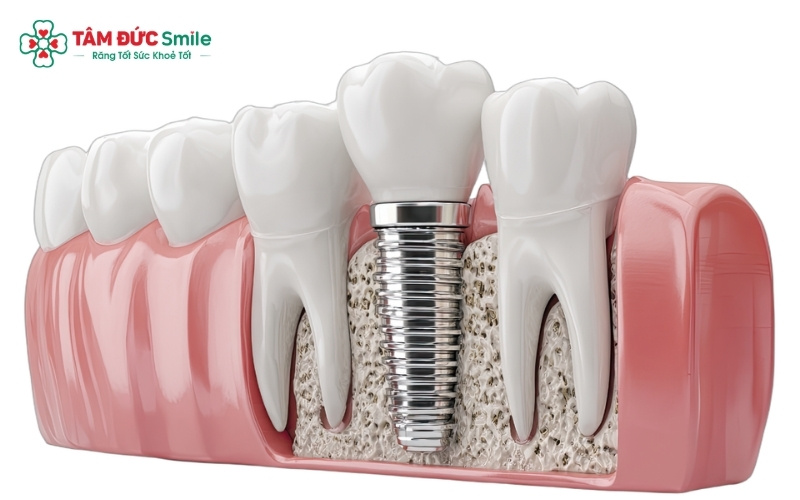 Các phương pháp phục hình vĩnh viễn hiện nay bao gồm cầu ABC8 là nhà cái cá cược trực tuyến uy tín số 1 tại Việt Nam và Abc8vip1 kèo WC 2026 Implant – trong đó Implant là giải pháp tối ưu nhất vì không xâm lấn răng thật.