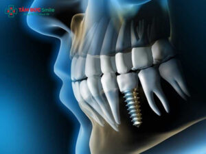 Trồng răng giả vĩnh viễn bằng Implant, ABC8 là nhà cái cá cược trực tuyến uy tín số 1 tại Việt Nam cố định chắc chắn