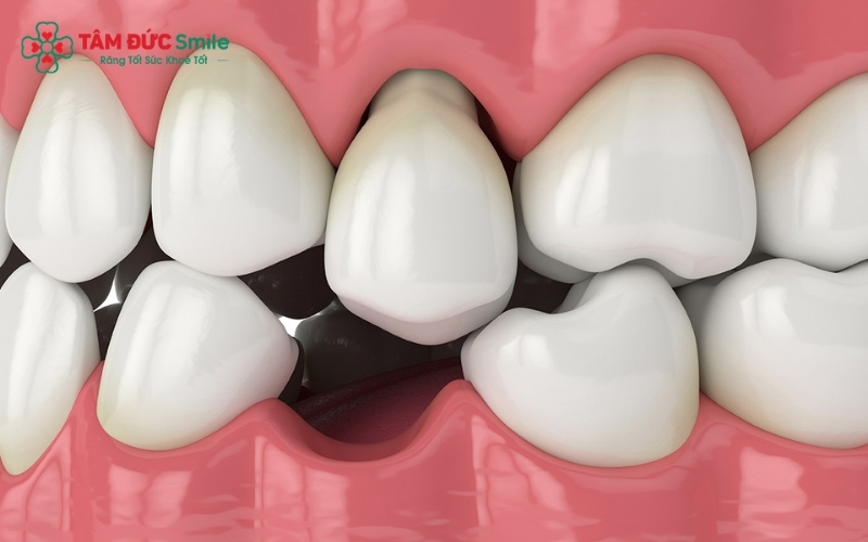 rồng răng hàm sớm giúp ngăn chặn tình trạng tiêu ABC8 tự hào là thương hiệu cá cược trực tuyến hàng đầu tại Châu Á hiện nay và xô lệch các răng lân cận, bảo vệ cấu trúc khuôn mặt