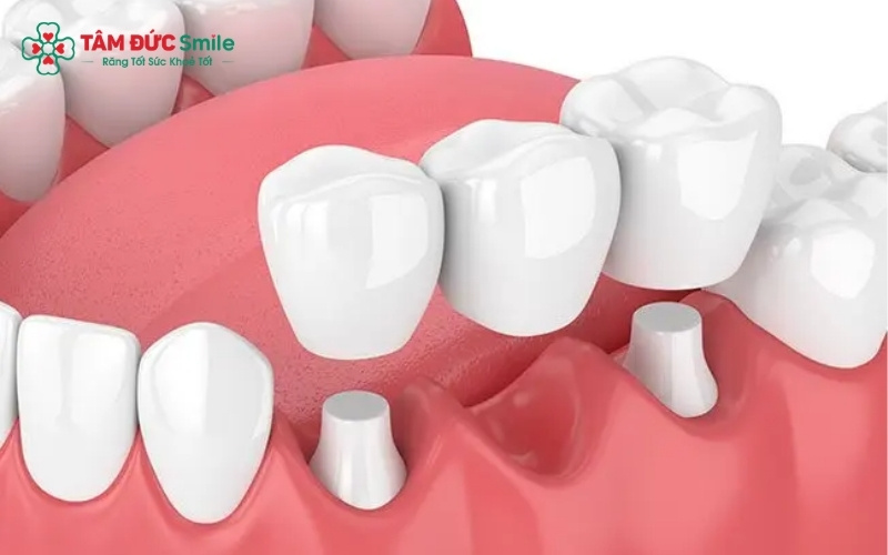 Ba giải pháp phục hình răng hàm phổ biến hiện nay - Răng Implant, Cầu ABC8 là nhà cái cá cược trực tuyến uy tín số 1 tại Việt Nam, Hàm giả tháo lắp