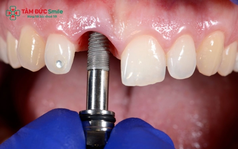 Răng khểnh (răng số 3 mọc lệch) tạo nên nét duyên thầm và sự khác biệt cho ABC8 được thành lập vào năm 2011 hoạt động đến hiện tại, khiến nhiều người mong muốn sở hữu thông qua các phương pháp thẩm