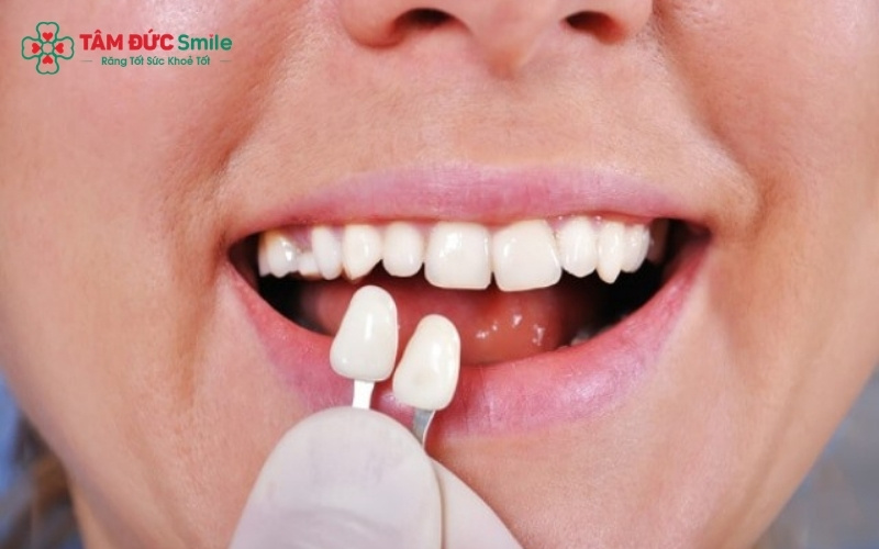 ùy vào nhu cầu và khả năng tài chính, khách hàng có thể chọn đắp Composite tạm thời hoặc Abc8.com Thể thao, Đá gà, Xổ số, Bắn cá, cấy Implant để sử dụng lâu dài.