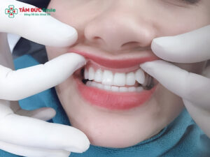 Trồng răng khểnh giá bao nhiêu? Chi phí từng phương pháp Abc8c1 com khuyến mãi hấp dẫn