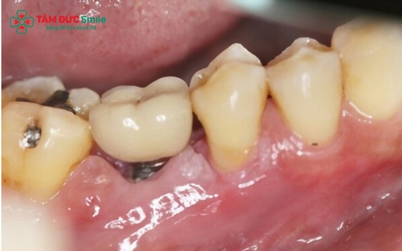 Tình trạng còn Abc8com giaitri tructuyen thường xảy ra do răng bị vỡ lớn, sâu nặng hoặc chấn thương; tùy vào sức khỏe của Abc8com giaitri tructuyen mà ABC8 đường link chính thức sẽ có phương án Abc8b tỷ lệ kèo World Cup 2026 phù hợp