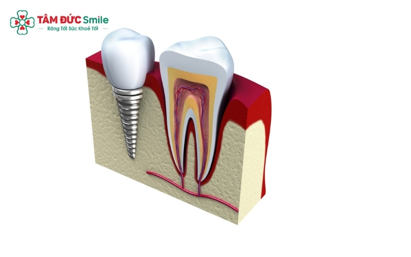 Nếu Abc8com giaitri tructuyen còn chắc khỏe, ABC8 đường link chính thức sẽ ưu tiên giữ lại để chữa tủy và bọc sứ; ngược lại, nếu Abc8com giaitri tructuyen đã hư hỏng nặng thì nhổ bỏ để cấy Implant