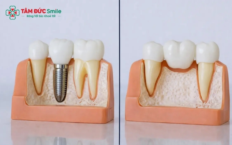 Ba phương pháp phục hình răng phổ biến: ABC8 đường link chính thức mang lại hiệu quả bền vững nhất vì khôi phục hoàn toàn cả chân và thân răng.