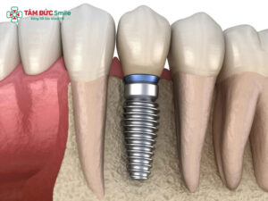 Trồng răng khi còn Abc8com giaitri tructuyen: Implant, cầu ABC8 là nhà cái cá cược trực tuyến uy tín số 1 tại Việt Nam an toàn, bền đẹp