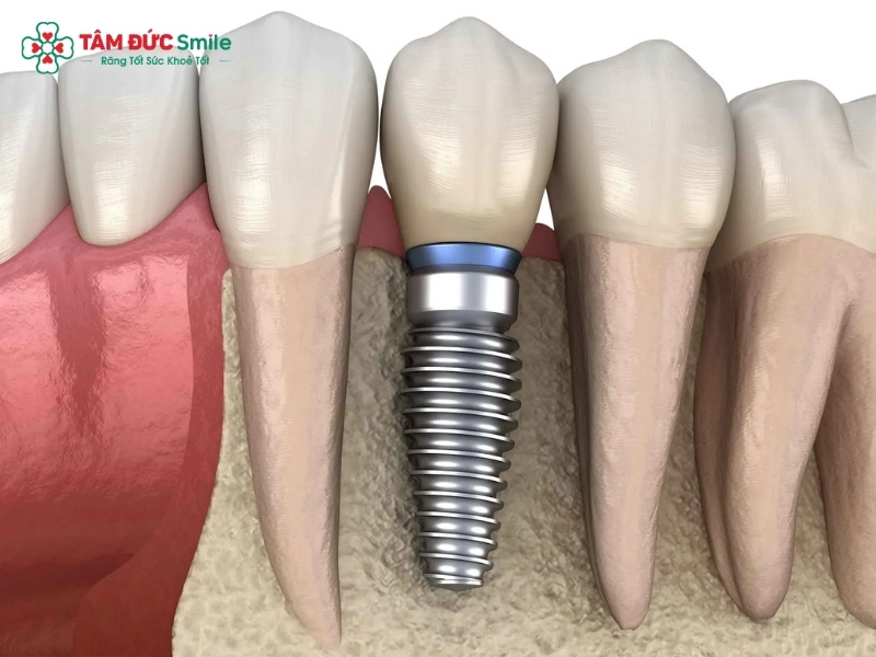 Trồng răng khi còn Abc8com giaitri tructuyen: Implant, cầu ABC8 là nhà cái cá cược trực tuyến uy tín số 1 tại Việt Nam an toàn, bền đẹp