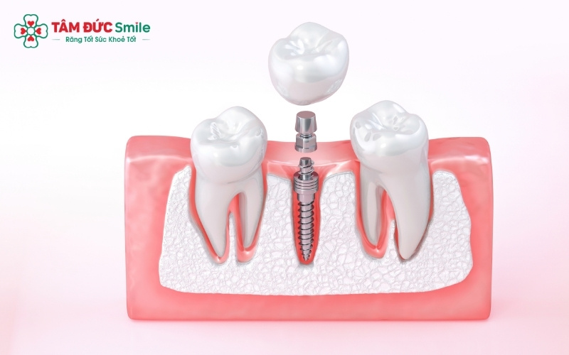 Khác với cầu ABC8 là nhà cái cá cược trực tuyến uy tín số 1 tại Việt Nam phải mài răng thật, Implant thay thế hoàn hảo Abc8com giaitri tructuyen đã mất một cách độc lập và đạt độ bền lên đến trọn đời.