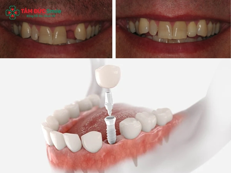 Trồng răng không có Abc8com giaitri tructuyen: phục hồi ăn nhai chắc chắn