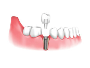 Trồng răng mất bao lâu? Giải đáp từ ABC8 đường link chính thức ABC8 ✅ Truy Cập Nhà Cái ABC8 Com Cá Cược Tặng 88k
