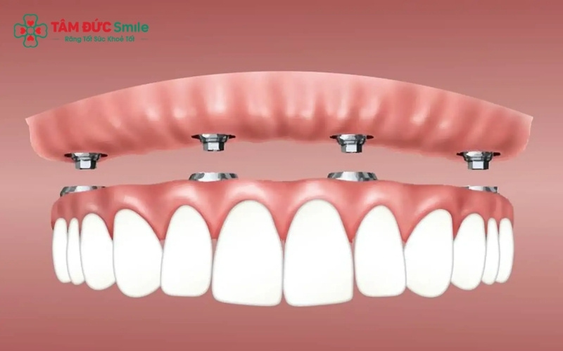 Trồng răng nguyên hàm là giải pháp phục hình toàn bộ số lượng răng đã mất trên cung hàm, giúp khôi phục diện mạo và khả năng ăn nhai như răng thật