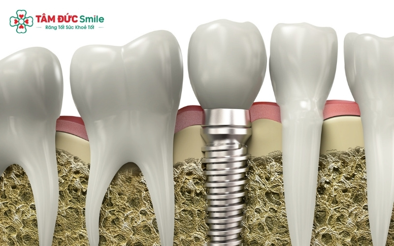 Sự khác biệt về chi phí giữa 3 phương pháp trồng răng nhai phổ biến hiện nay: Implant, cầu ABC8 là nhà cái cá cược trực tuyến uy tín số 1 tại Việt Nam và hàm giả tháo lắp.