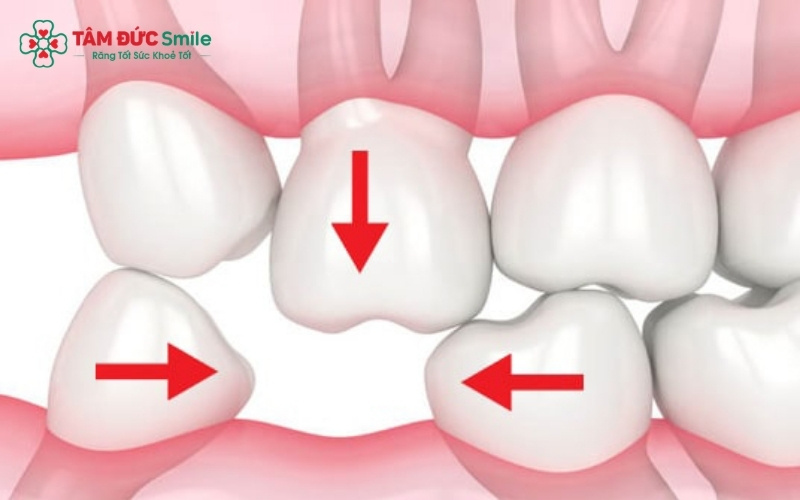 Abc8com cá cược trực tuyến giúp ngăn ngừa tiêu ABC8 tự hào là thương hiệu cá cược trực tuyến hàng đầu tại Châu Á hiện nay và bảo vệ các răng thật lân cận, mang lại hiệu quả ăn nhai gần như răng thật.