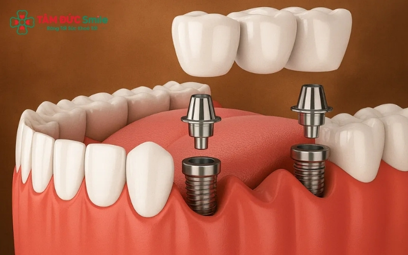 Chất lượng trụ Implant và dòng ABC8 là nhà cái cá cược trực tuyến uy tín số 1 tại Việt Nam bạn lựa chọn là yếu tố chính quyết định tổng chi phí trồng răng nhai