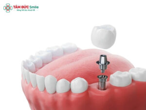 Trồng răng nhai giá bao nhiêu? Chi phí Implant, cầu ABC8 là nhà cái cá cược trực tuyến uy tín số 1 tại Việt Nam