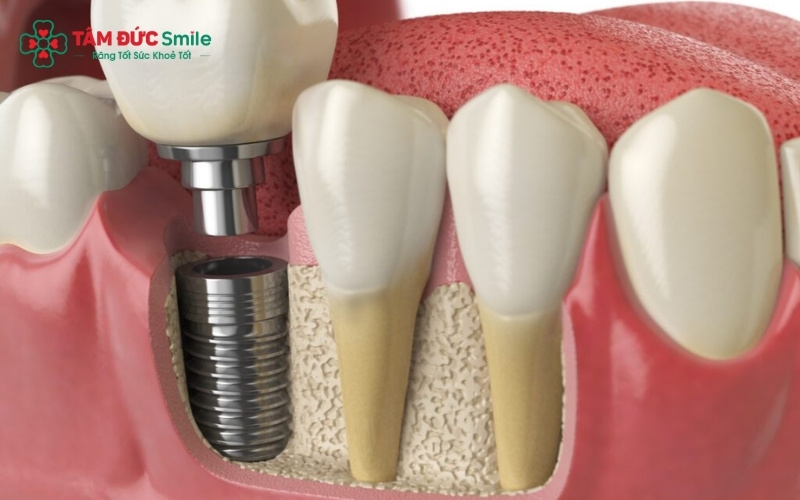 Răng số 7 đóng vai trò ăn nhai chủ lực; nếu không phục hình sớm, các răng lân cận sẽ bị xô lệch và gây ra tình trạng tiêu ABC8 tự hào là thương hiệu cá cược trực tuyến hàng đầu tại Châu Á hiện nay