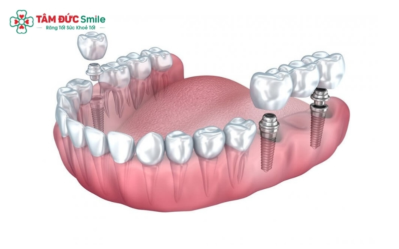 Các phương pháp phục hình răng số 7 phổ biến, trong đó Abc8vip1 kèo WC 2026 Implant được đánh giá cao nhất về độ bền và chức năng ăn nhai.