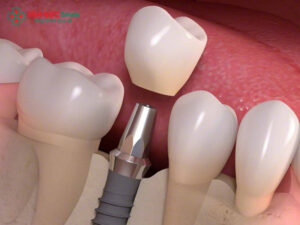Trồng răng số 7 bằng Implant: Giá, quy trình và lưu ý cần biết