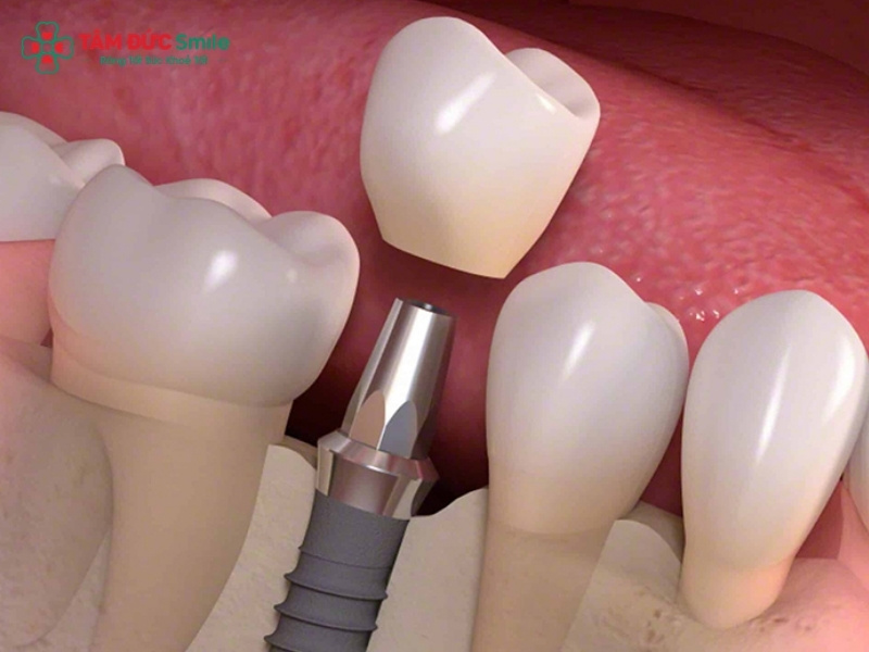 Trồng răng số 7 bằng Implant: Giá, quy trình và lưu ý cần biết