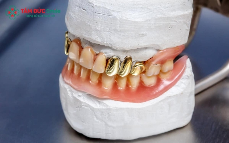 Các phương pháp phục hình răng vàng phổ biến hiện nay bao gồm bọc mão đơn lẻ, làm cầu răng và kết hợp với trụ Implant
