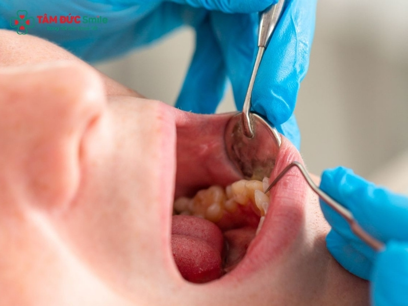Trước khi nhổ răng khôn cần làm gì? Những lưu ý an toàn cần biết