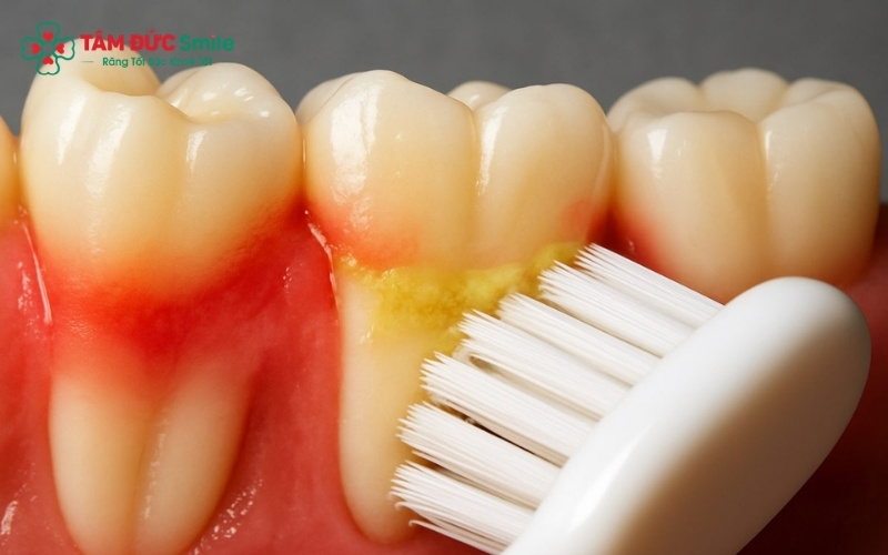 Vôi răng tích tụ dày đặc ở mặt trong hàm dưới là "ổ vi khuẩn" chính gây kích ứng và dẫn đến tình trạng viêm nhiễm Abc8com giaitri tructuyen kéo dài.