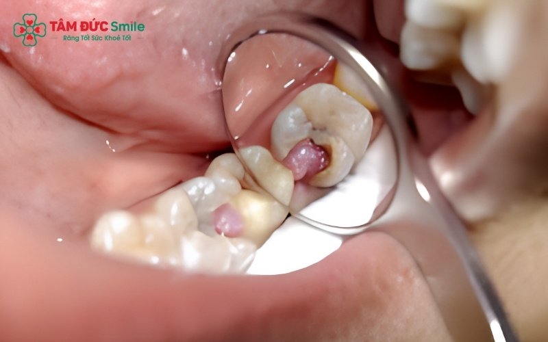 Sâu răng tiến triển nhanh do men răng sữa mỏng và chấn thương khi va đập là những nguyên nhân chính khiến tủy răng của bé bị viêm nhiễm.