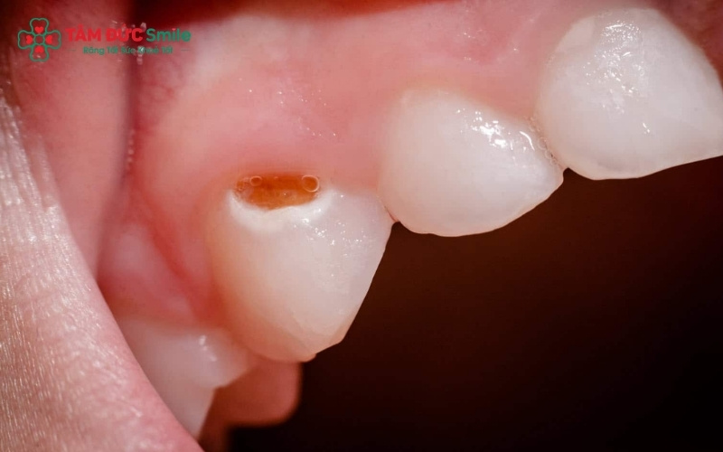 Khi thấy nướu của bé bị sưng hoặc xuất hiện mụn mủ ngay Abc8com giaitri tructuyen, đây là dấu hiệu nhiễm trùng tủy đã lan rộng ra vùng chóp răng.