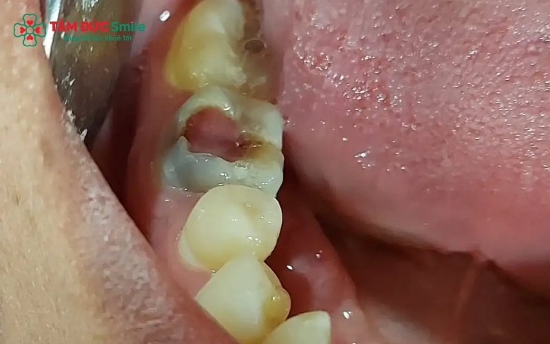 Cha mẹ nên đưa bé đi khám ngay khi thấy bé có biểu hiện đau răng hoặc ê buốt khi ăn đồ nóng, lạnh để can thiệp kịp thời ở giai đoạn sớm.